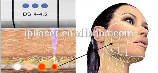 L'occhio messo a fuoco ad alta intensità di ultrasuono di Hifu insacca la rimozione della fronte del collo
