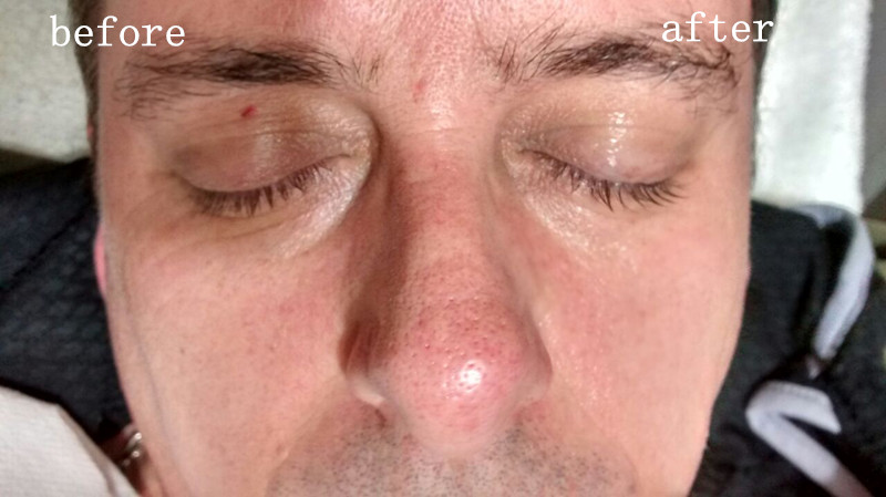 L'occhio messo a fuoco ad alta intensità di ultrasuono di Hifu insacca la rimozione della fronte del collo